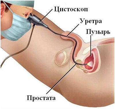 Дивертикулез мочевого пузыря: симптомы, диагностика, лечение6