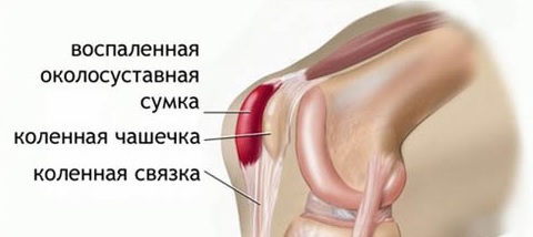 Тендовагиниты и остеохондропатии: симптомы и лечение6