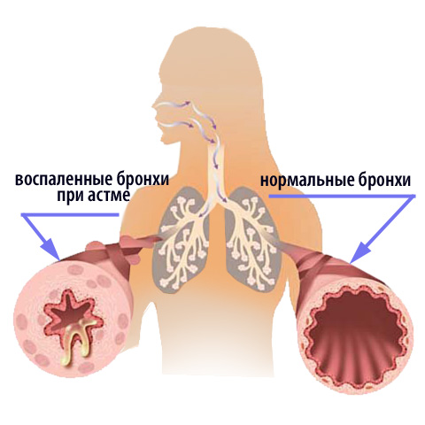 Экзогенный аллергический альвеолит: лечение6