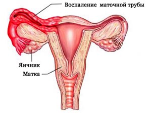 Беременность после лапароскопии 6