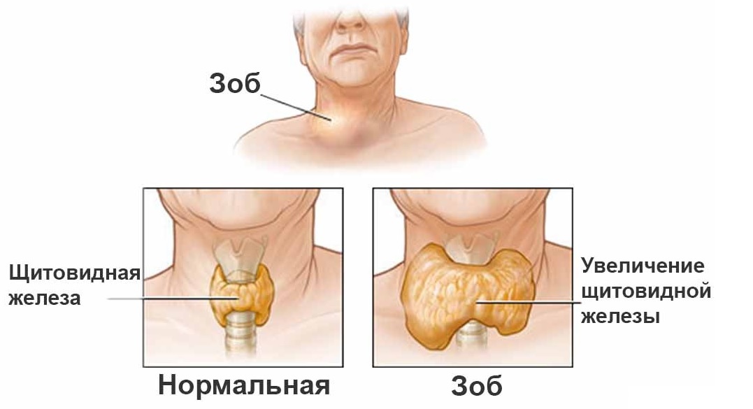 Сахарный диабет 2 типу у детей и другие эндокринные заболевания6