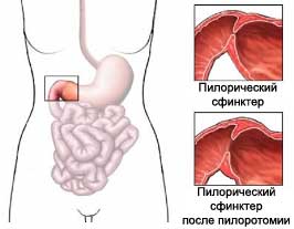 Рвота у ребенка: причины, симптомы, лечение, лекарственные препараты6