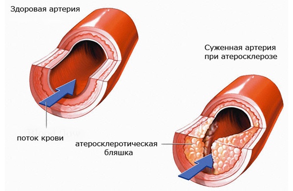 Болят икры ног, что делать?6