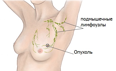 Киста молочной железы: причины, диагностика, лечение6