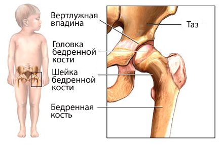 Дисплазия тазобедренного сустава у новорожденных: лечение, фото и ведео  6
