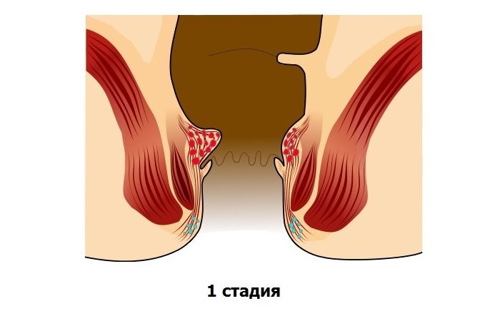 Внутренний геморрой: симптомы, лечение, причины возникновения7