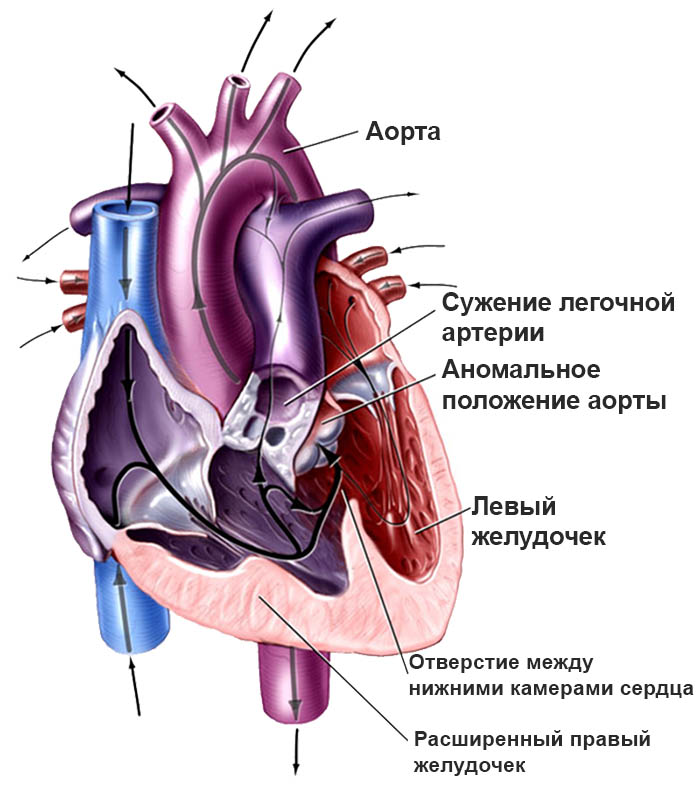 Тетрада Фалло: описание, диагностика, методы лечения, рекомендации врачей7