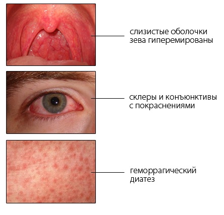 Что такое Лихорадка? Денге, Лаоса, Эбола, Желтая7