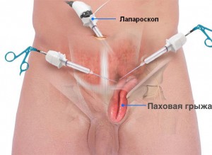 Паховая грыжа у мужчин симптомы, осложнения, лечение, фото7