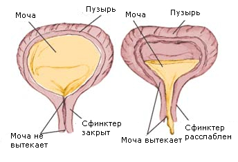 Дивертикулез мочевого пузыря: симптомы, диагностика, лечение7