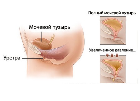 Радикальная простатэктомия послеоперационный период: прогноз7