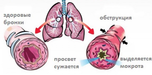 Пылевой бронхит: симптомы и лечение7