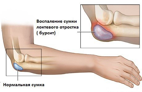 Тендовагиниты и остеохондропатии: симптомы и лечение7