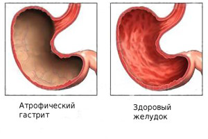 Интоксикация хлорорганическими соединениями7