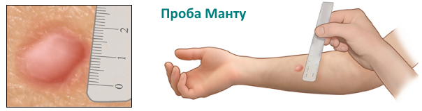 Субфебрильная температура: причины, лечение, у ребенка, у женщин7