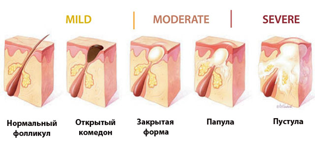 Угревая сыпь: лечение ботулотоксином, последствия, отзывы, фото7