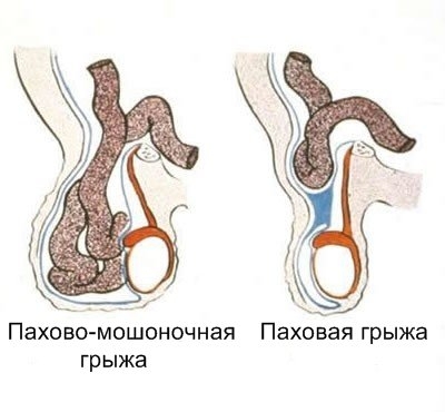 Инвагинация кишечника у детей: причины, симптомы, лечение7