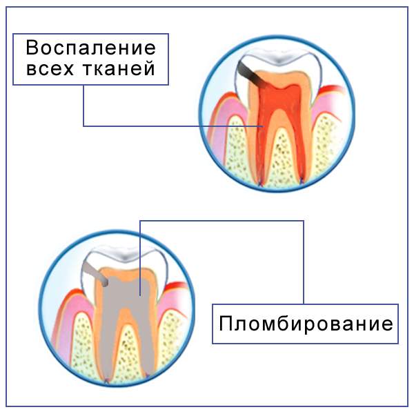 Остеотомия и резекция верхушки корня. Ультразвуковая резекция7