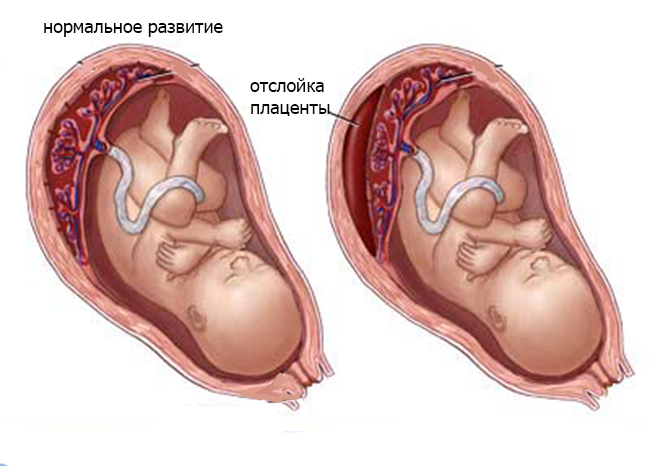 Отслойка плаценты: симптомы, лечение на разных сроках7