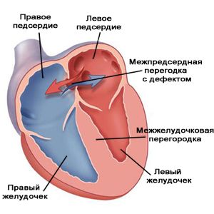 Гипоплазия правого желудочка: диагностика, способы лечения7