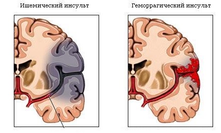 Стеноз аортального клапана: лечение, операция7