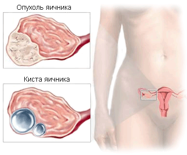 Миома матки: симптомы, лечение, операция7