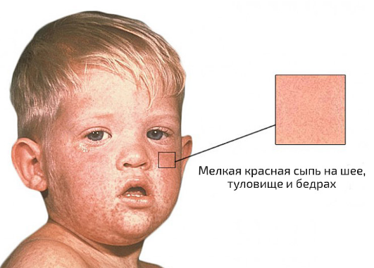 Что такое вирусы? Симптомы, диагностика и лечение вирусов7