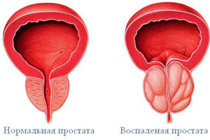 Жжение и боль при мочеиспускании у женщин и мужчин, лечение7