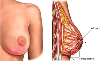 Боль в молочной железе: причины, симптомы, лечение7