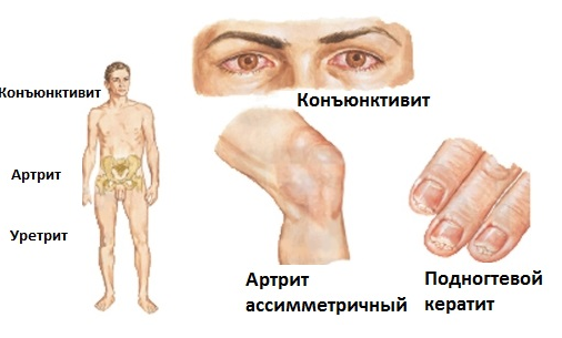 Хламидиоз: лечение, препараты, симптомы у мужчин и женщин8