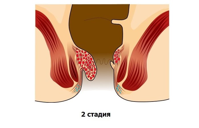 Внутренний геморрой: симптомы, лечение, причины возникновения8