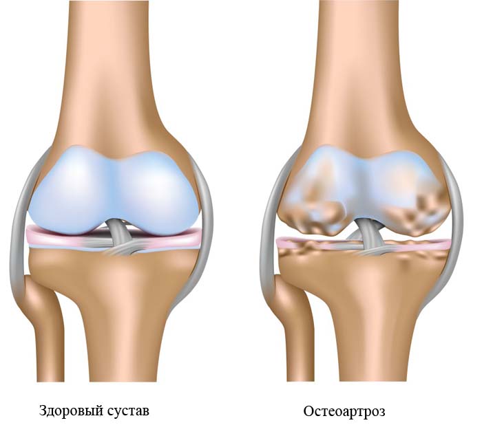 Болят кисти рук, что делать?8