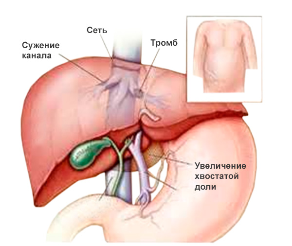 Цирроз печени: симптомы, лечение, стадии8