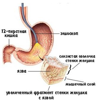 Язва желудка: симптомы, лечение, народные средства8