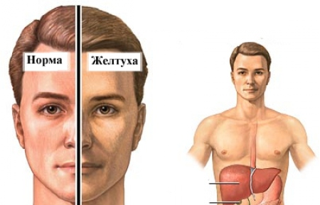 Заболевания печени: признаки, симптомы, анализы8