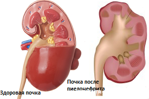 Острый и хронический пиелонефрит8