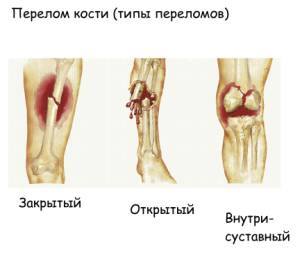 Перелом или вывих или ушиб или растяжение8