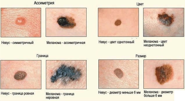 Сосудистые лазеры. Удаление пигментных пятен лазером, отзывы, цена8