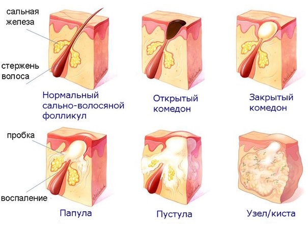 Угревая сыпь: лечение ботулотоксином, последствия, отзывы, фото8