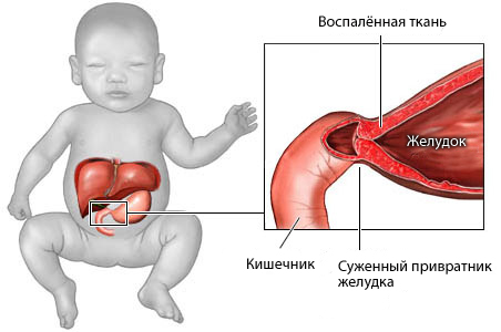 Рвота у ребенка: причины, симптомы, лечение, лекарственные препараты8