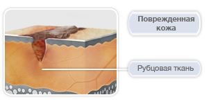 Фолликулиты: классификация, симптомы, лечение8