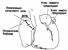 Осложнения при тетраде Фалло. Атрезия легочной артерии8