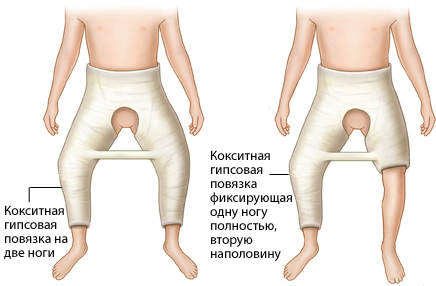 Дисплазия тазобедренного сустава у новорожденных: лечение, фото и ведео  8