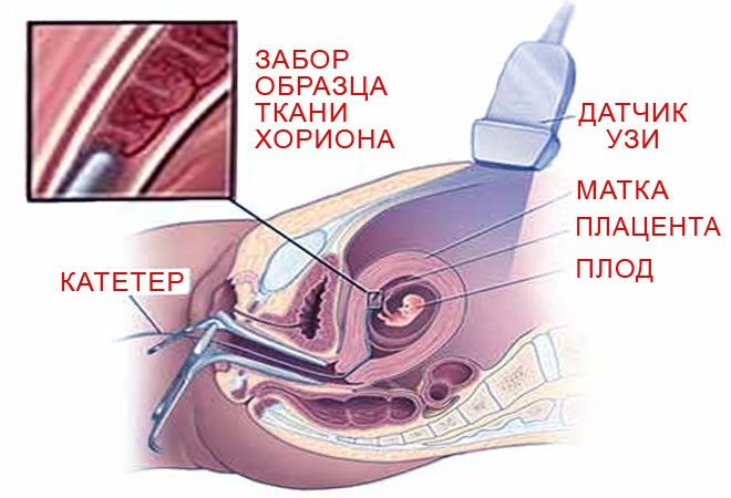 Скрининг при беременности: ультразвуковой, скрининг пороков развития9