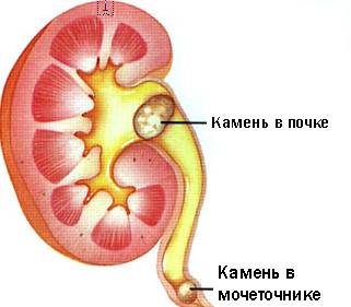 Камни мочеиспускательного канала у детей: лечение9