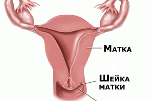 Осложнения гонореи у женщин и у мужчин9