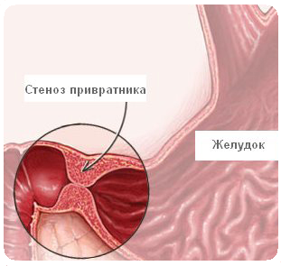 Язва двенадцатиперстной кишки: симптомы, лечение, диета, фото9