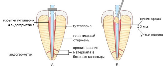Реплантация зуба. Методики эндодонтического лечения зубов после травмы9