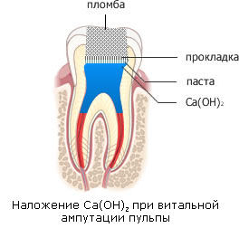 Пульпотомия. Методика пульпотомии молочных зубов9