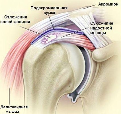 Боль в плечевом суставе: симптомы, лечение, причины, дискомфорт при поднятии руки9